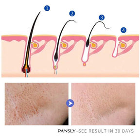 Permanent Hair Removal Cream - Stop Growth, Painless